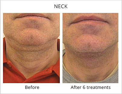 Before and after the neck treatment