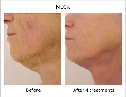 Before and after the neck treatment